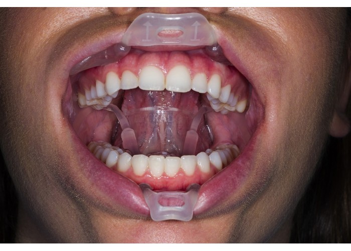 Ultradent - λευκανση - δοντια - Umbrella  Large - Παρειοκάτοχο, γλωσσοκάτοχο, στοματοδιαστολέας Opalescence Boost 40% - Λεύκανση δοντιών στο ιατρείο